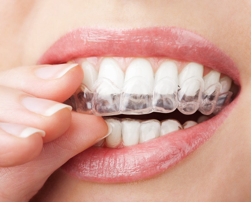 Clear Aligners in McAllen