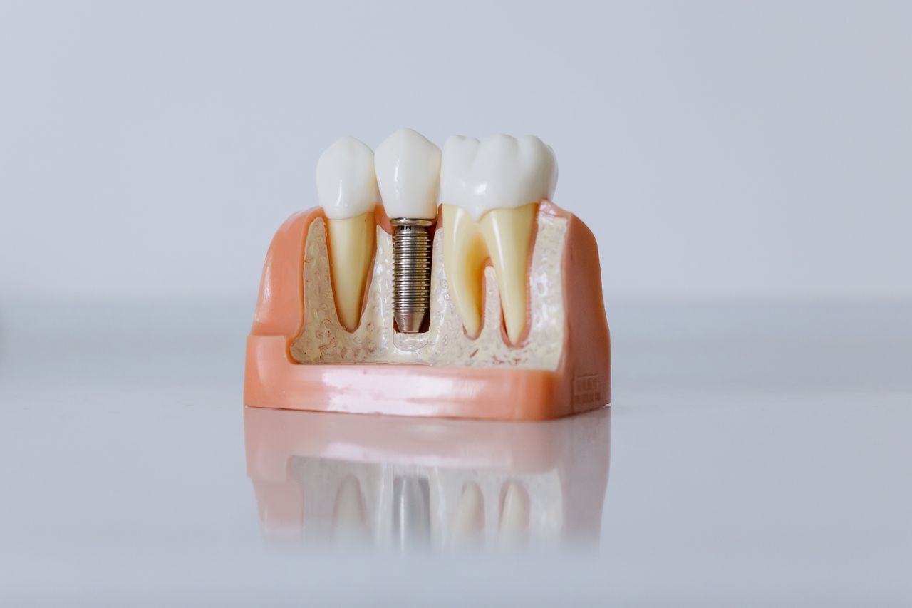 Dental Implants in  McAllen, TX
